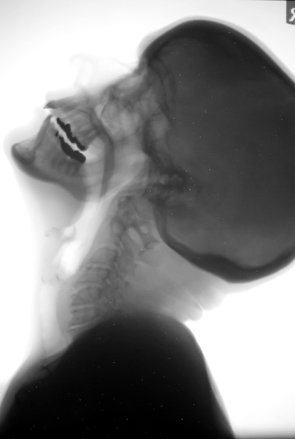 Рентген глубокой глотки. Рентгеновский снимок минета. Рентген глубокого горла. Рентгеновские снимки глубокого отсоса.